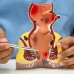 лазерно лечение на хемороиди