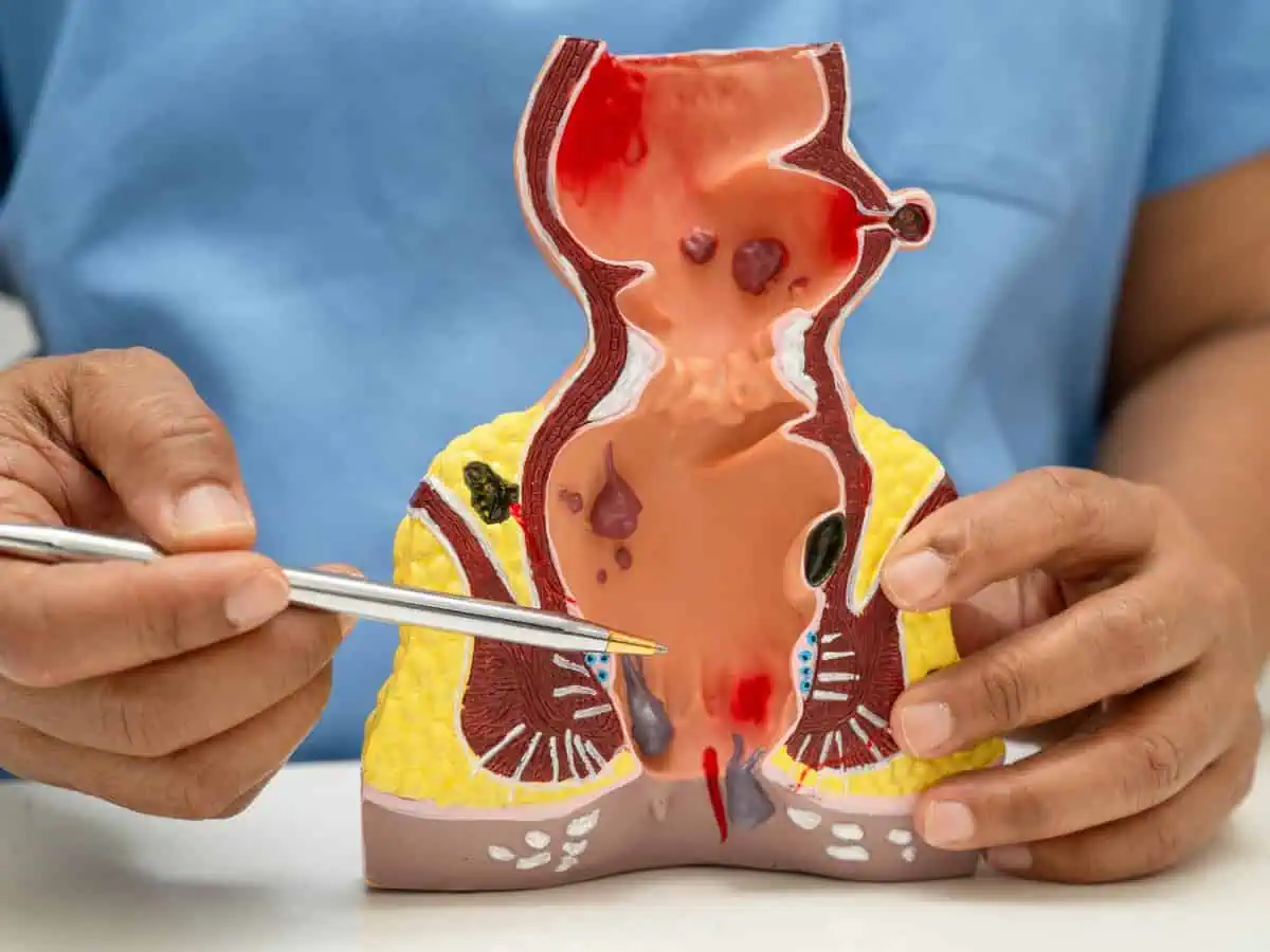 лазерно лечение на хемороиди