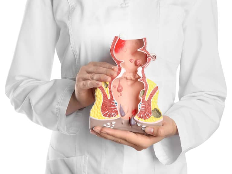 Как изглеждат хемороидите