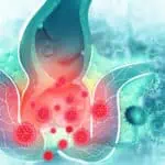 какво е анална фисура