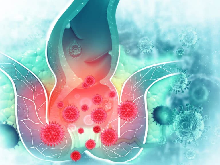 какво е анална фисура